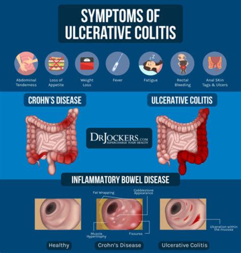 uc can|can uc go into remission.